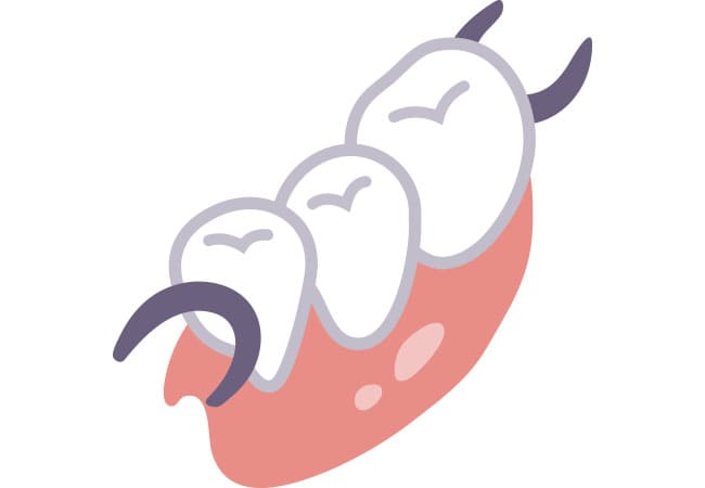 部分入れ歯のイラスト1
